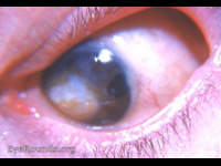 optical iridectomy
