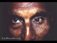 varices, orbital