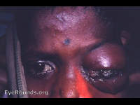 marked orbital cellulitis