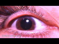meibomian gland orefice plugs