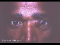 ossifying fibroma: nose and left orbit