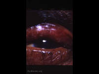 osteomyelitis fistula of frontal bone (related to sinusitis)