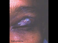 osteomyelitis of frontal bone with draining fistula