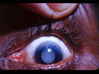 Pannus -superior limbus with Morgagnian cataract