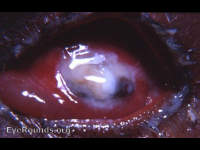 ultimate post-op ocular complication of cataract surgery
