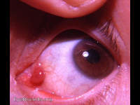 pedunculated papilloma of the caruncle
