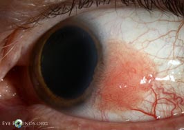 Conjunctival squamous papilloma