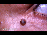 pigmented papilloma with hair