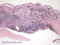 conjunctival melanoma