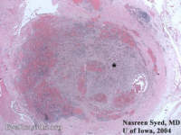 cavernous hemangioma