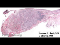 conjunctival melanoma