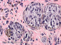conjunctival melanoma