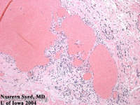 cavernous hemangioma