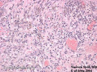 cavernous hemangioma