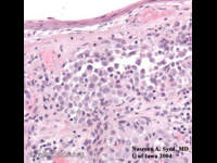 conjunctival melanoma