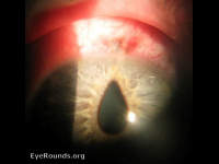 peaked pupil from open globe