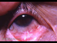 Ocular pemphigoid