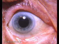 intracapsular cataract operation