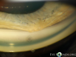 Synechia in iridocorneal endothelial syndrome, High peripheral