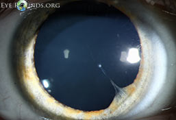 Persistent pupillary membranes