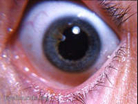 persistent pupillary membrane with anterior polar-like cataract