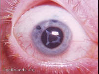 phacoemulsification in its early years