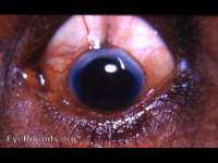 Phthisis bulbi, post cataract surgery
