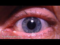 pilosebaceous lid margin cyst