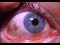 pigmented nevus of bulbar conjunctiva