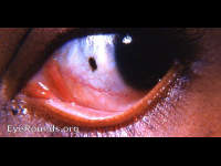 pigmented nevus of conjunctiva