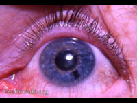 pigmented nevus of iris