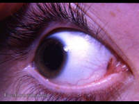 pigmentation of plica semilunaris