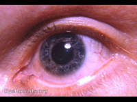 pigmented punctum lacrimalis OS