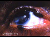 pigmented nevi of lid margins