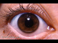 pigmented nevus of right lower lid