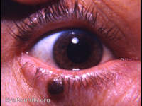 pigmented papilloma of eyelid