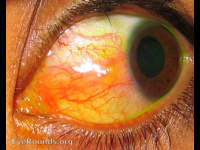 inflamed pinguecula