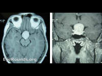 pituitary adenoma