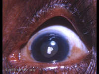 Anterior polar cataract