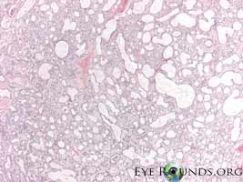pleomorphic adenoma