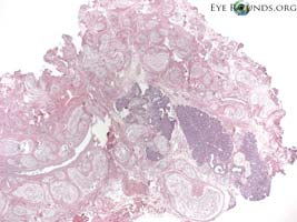 plexiform neurofibroma