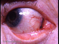 pigmented nevus of plica semilunaris