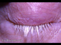 poliosis of lashes