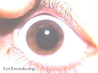 polycoria (false)