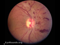 regressing proliferative diabetic retinopathy after PRP laser