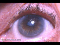 post-endophthalmitis membrane with anterior uveitis, seclusio pupillae, and iris atrophy - all following uncomplicated intracapsular cataract operation.