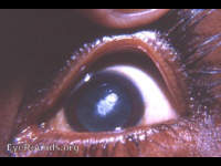 posterior polar cataract