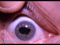 anterior uveitic posterior synechiae, ectropion uveae, and nuclear cataract