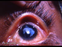 Aftercataract