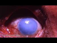 total corneal decompensation with diffuse epithelial edema following cataract surgery